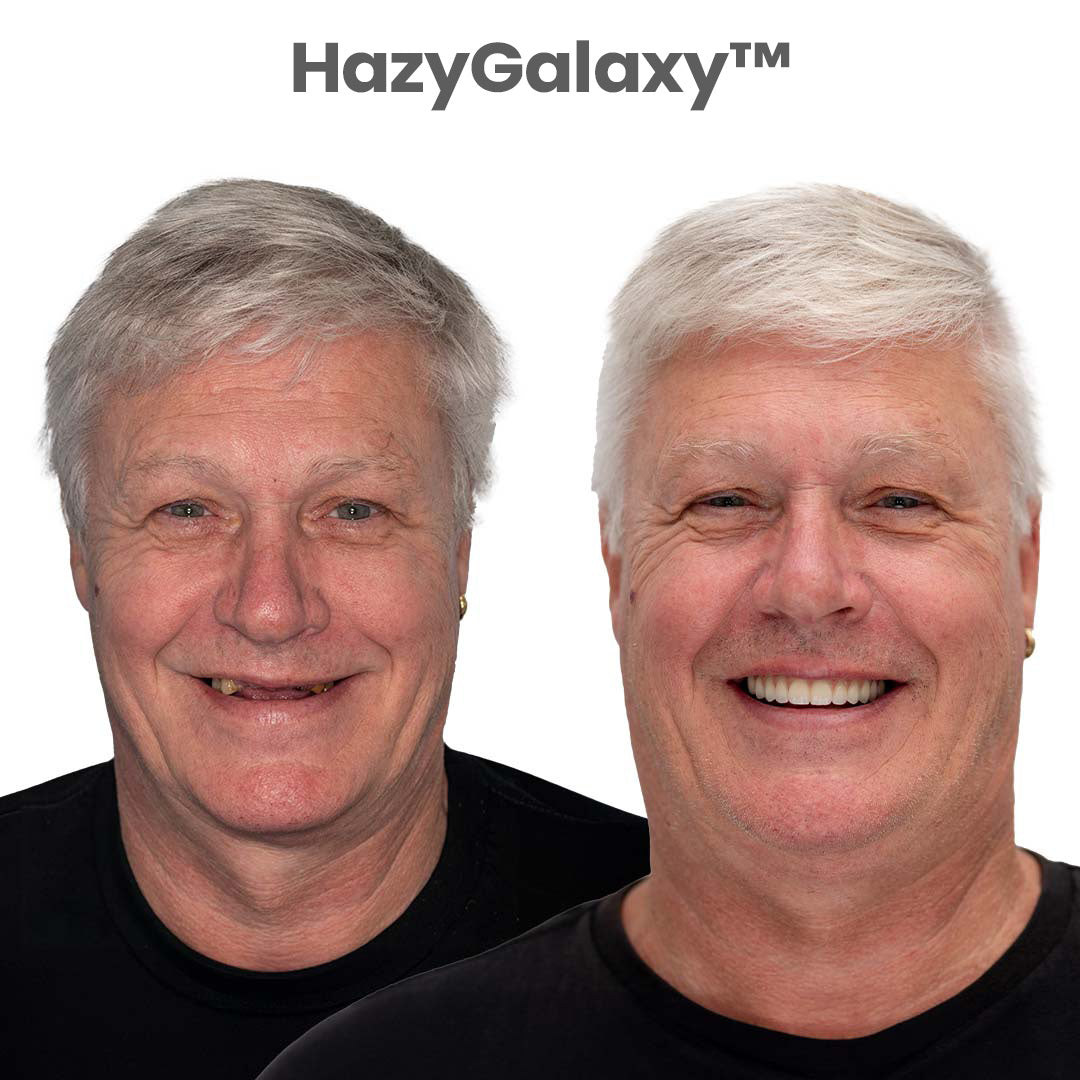 🦷 HazyGalaxy™ Custom-Fit Dentures ⏰ ENDS TODAY 80% OFF🔥 Smile with Confidence
